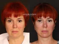 Результати до і після підтяжки обличчя в Dr. VRUBLIVSKYI Plastic Surgery, омолодження