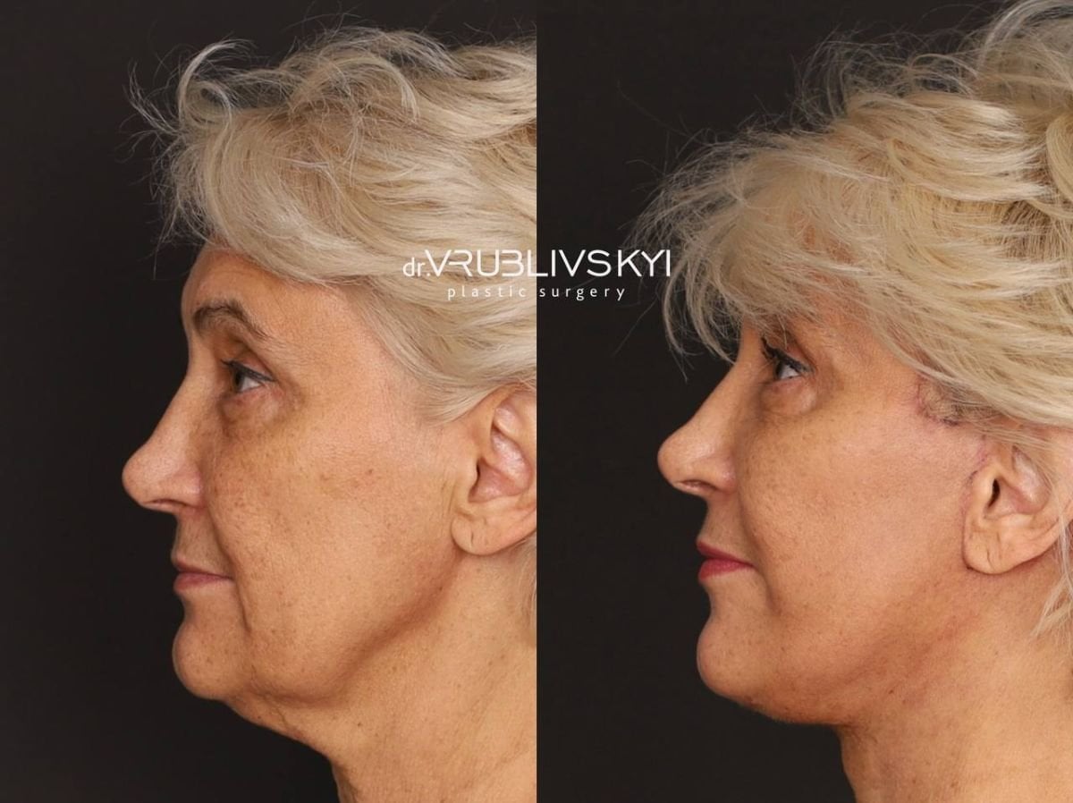 Resultados de lifting facial antes y después en Dr. VRUBLIVSKYI Plastic Surgery, rejuvenecimiento