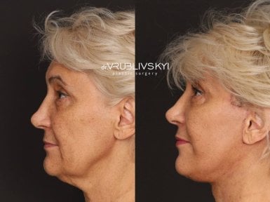 نتائج شد الوجه قبل وبعد في Dr. VRUBLIVSKYI Plastic Surgery، تجديد شباب الوجه