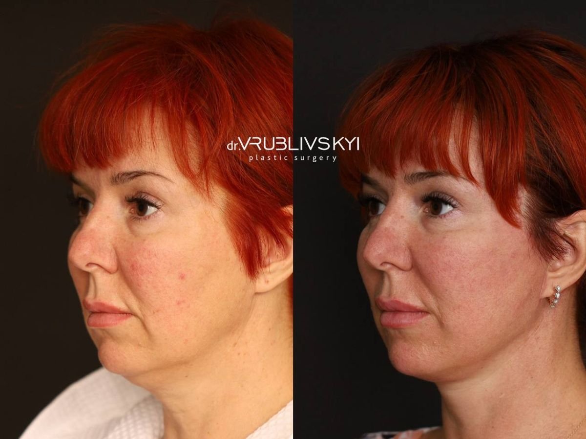 Facelift Vorher-Nachher-Ergebnisse bei Dr. VRUBLIVSKYI Plastic Surgery, sichtbare Verjüngung