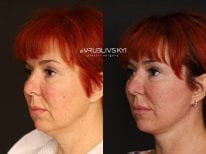 Результати до і після підтяжки обличчя в Dr. VRUBLIVSKYI Plastic Surgery, омолодження