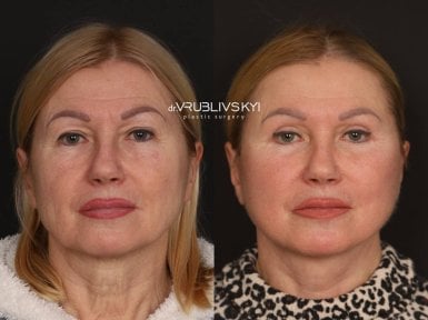 Результати до та після підтяжки обличчя в Dr. VRUBLIVSKYI Plastic Surgery, омолодження