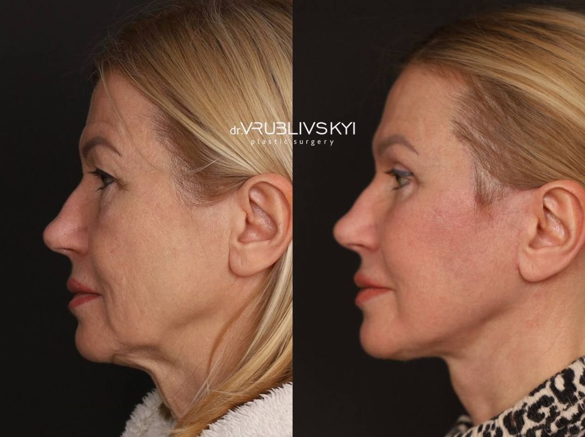Facelift Vorher-Nachher-Ergebnisse bei Dr. VRUBLIVSKYI Plastic Surgery, sichtbare Verjüngung