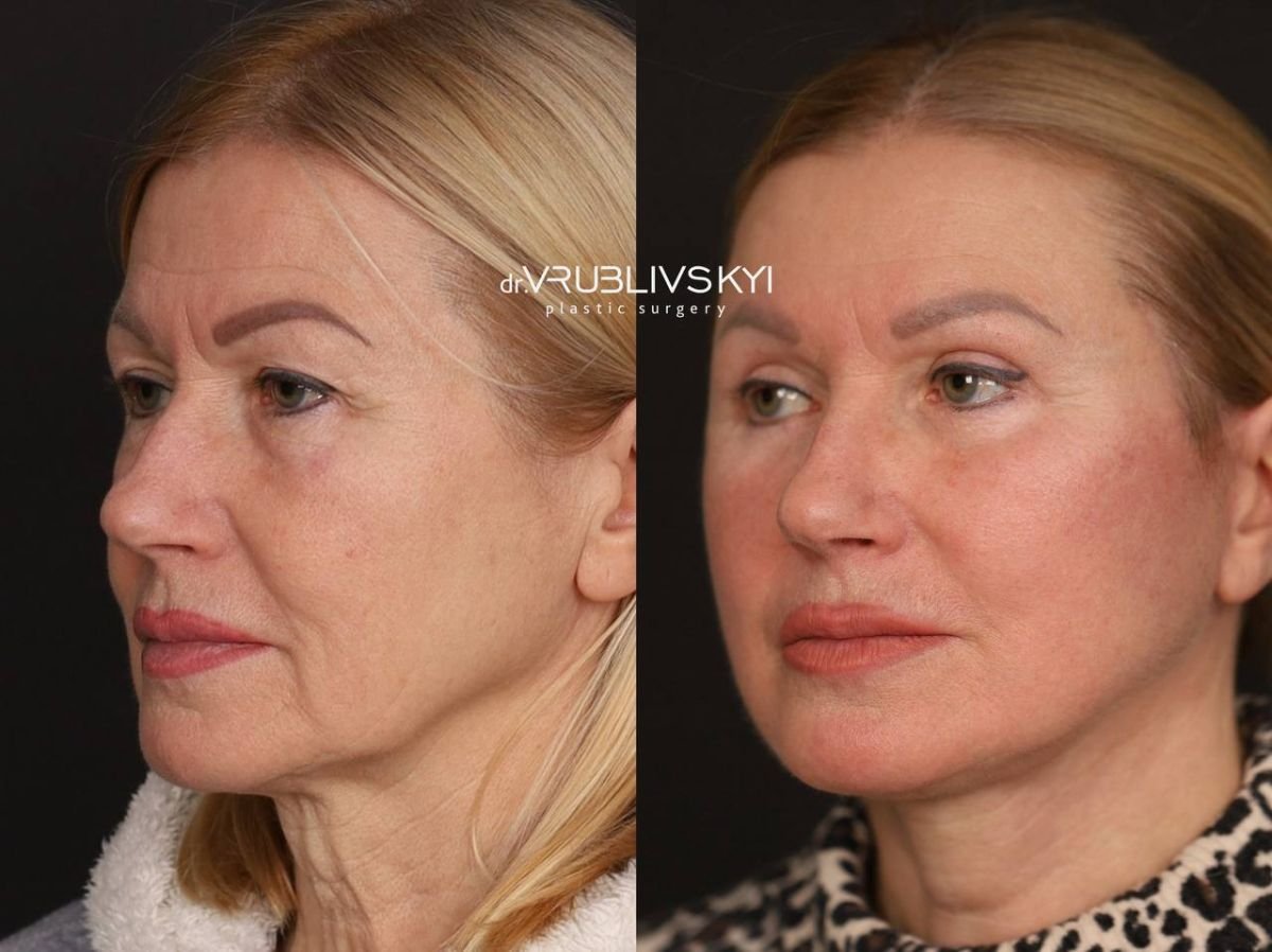 Facelift Vorher-Nachher-Ergebnisse bei Dr. VRUBLIVSKYI Plastic Surgery, sichtbare Verjüngung
