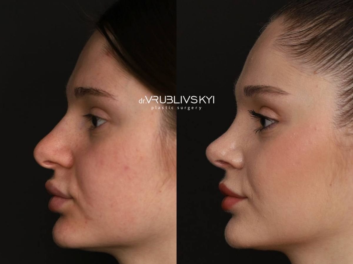 Resultados de rinoplastia antes y después en Dr. VRUBLIVSKYI Plastic Surgery, perfil mejorado