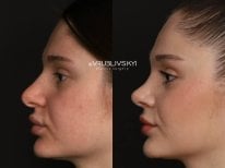 نتائج تجميل الأنف قبل وبعد في Dr. VRUBLIVSKYI Plastic Surgery، تحسين شكل الأنف
