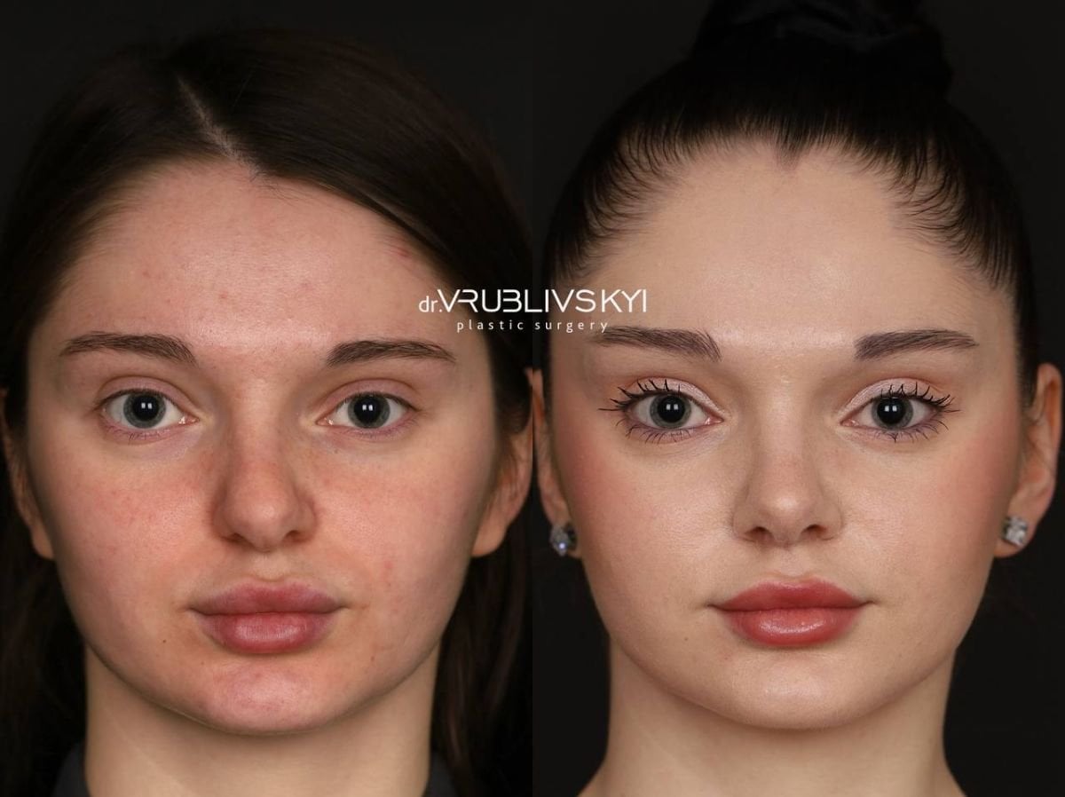 Resultados de rinoplastia antes y después en Dr. VRUBLIVSKYI Plastic Surgery, remodelación nasal