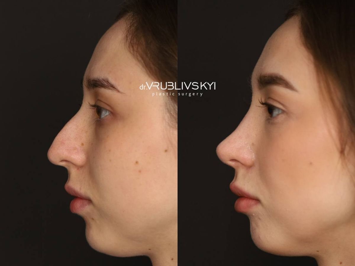 نتائج عملية تجميل الأنف قبل وبعد في Dr. VRUBLIVSKYI Plastic Surgery، إعادة تشكيل الأنف