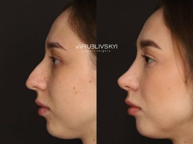 Résultats avant/après rhinoplastie chez Dr. VRUBLIVSKYI Plastic Surgery, remodelage du nez