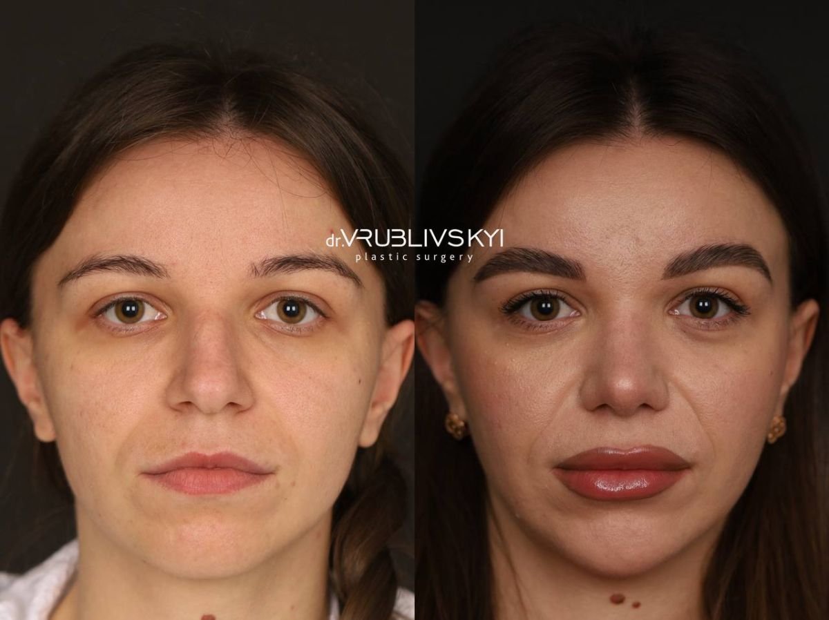 Результати ринопластики до і після в Dr. VRUBLIVSKYI Plastic Surgery, корекція носа
