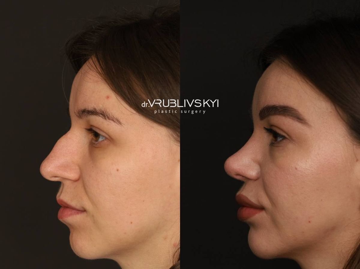 Результати ринопластики до і після в Dr. VRUBLIVSKYI Plastic Surgery, корекція носа