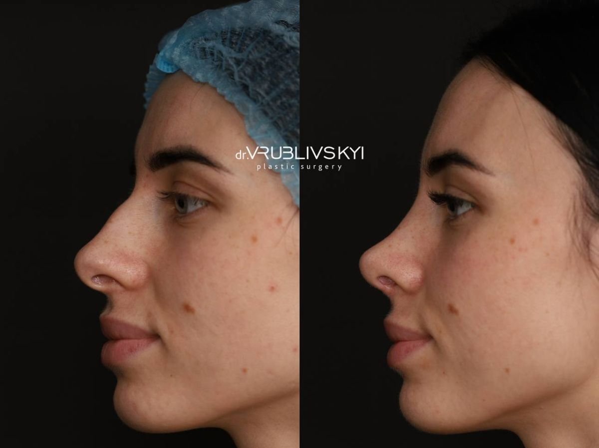 Результати ринопластики до і після в Dr. VRUBLIVSKYI Plastic Surgery, корекція носа