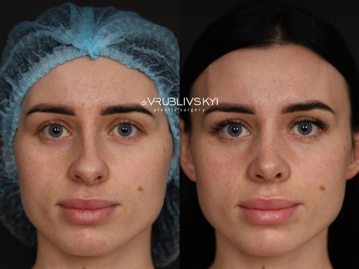 Результати ринопластики до і після в Dr. VRUBLIVSKYI Plastic Surgery, корекція носа