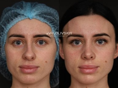Результати ринопластики до і після в Dr. VRUBLIVSKYI Plastic Surgery, корекція носа