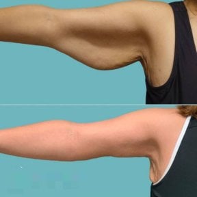 Before and after arm liposuction results at ID Clinic Bangkok, improved arm contour visible