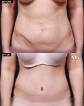 Результати абдомінопластики до і після у VG Plastic Surgery – покращений контур живота