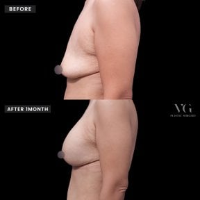 Vorher-nachher Brustvergrößerung bei VG Plastic Surgery, sichtbare Volumenzunahme
