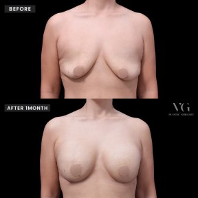 Vorher-nachher-Ergebnis Brustvergrößerung bei VG Plastic Surgery, sichtbare Verbesserung nach 1 Monat