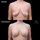 Vorher-nachher-Ergebnis Brustvergrößerung bei VG Plastic Surgery, sichtbare Verbesserung nach 1 Monat