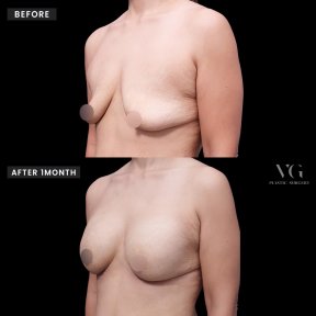 Vorher-nachher-Ergebnis Brustvergrößerung bei VG Plastic Surgery, verbesserte Brustform