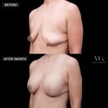 Vorher-nachher-Ergebnis Brustvergrößerung bei VG Plastic Surgery, verbesserte Brustform