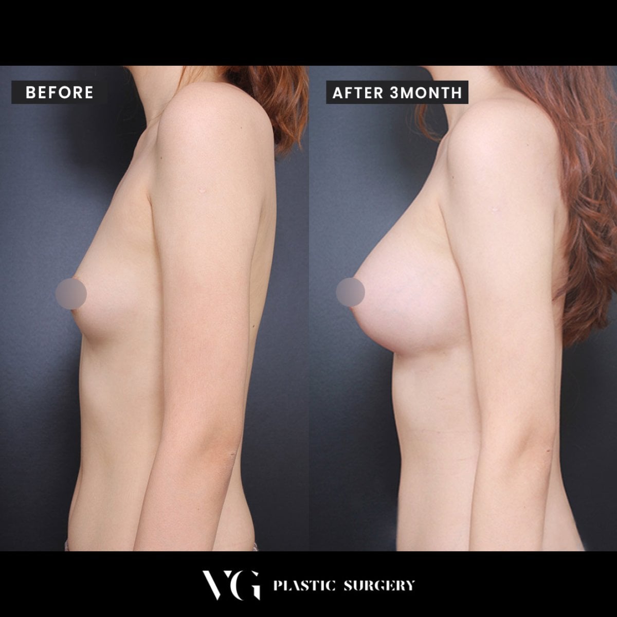 Resultados antes y después de aumento de senos en VG Plastic Surgery, mayor volumen mamario