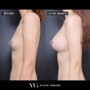 Vorher-nachher-Ergebnis Brustvergrößerung bei VG Plastic Surgery, mehr Brustvolumen