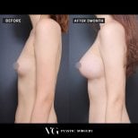 Vorher-nachher-Ergebnis Brustvergrößerung bei VG Plastic Surgery, mehr Brustvolumen