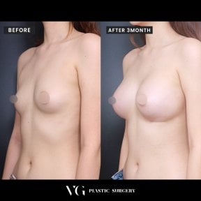 Vorher-nachher-Ergebnis Brustvergrößerung bei VG Plastic Surgery, mehr Brustvolumen