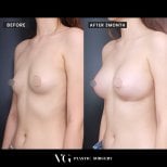 Vorher-nachher-Ergebnis Brustvergrößerung bei VG Plastic Surgery, mehr Brustvolumen