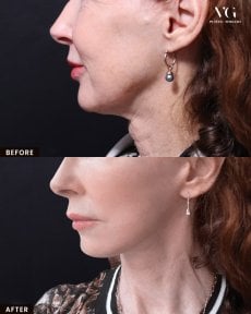 Before and after neck lift results at VG Plastic Surgery, visible neck contour improvement