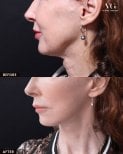 Before and after neck lift results at VG Plastic Surgery, visible neck contour improvement