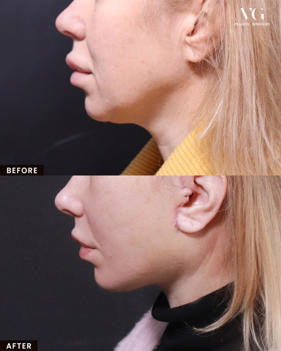 نتائج شد الرقبة قبل وبعد في VG Plastic Surgery، تحسين واضح لخط الفك والرقبة