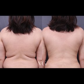 Before and after back liposuction results at VG Plastic Surgery – visible fat reduction
