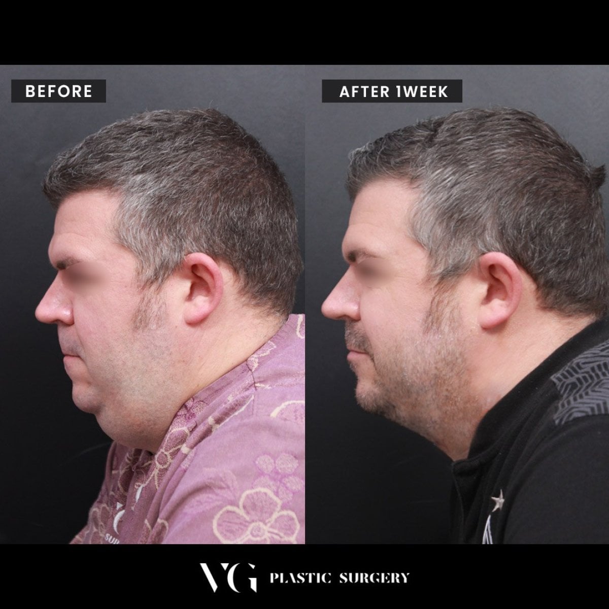 قبل وبعد شفط دهون الذقن المزدوج في VG Plastic Surgery، تحسن واضح للفك
