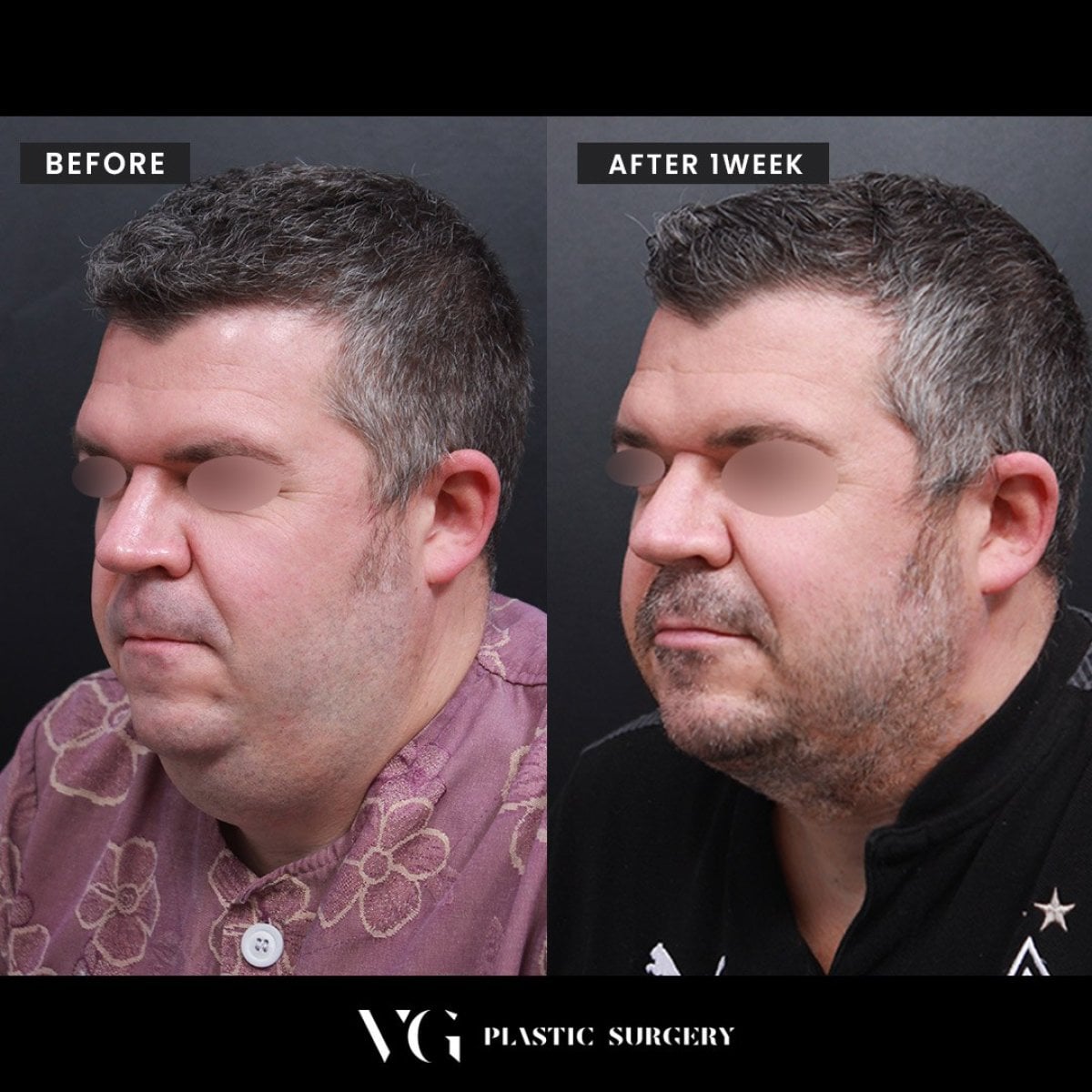 Resultados de liposucción de papada en VG Plastic Surgery, mejora visible de la mandíbula