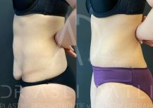 Vorher-nachher-Ergebnis 360°-Liposuktion bei Liv Hospital Ulus, verbesserte Bauchkontur