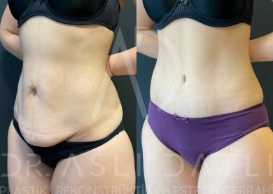 Vorher-nachher-Ergebnisse 360°-Liposuktion bei Liv Hospital Ulus, verbesserte Bauchkontur