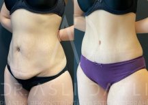 Vorher-nachher-Ergebnisse 360°-Liposuktion bei Liv Hospital Ulus, verbesserte Bauchkontur