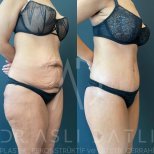 Vorher-nachher-Ergebnis 360°-Liposuktion bei Liv Hospital Ulus, verbesserte Bauchkontur