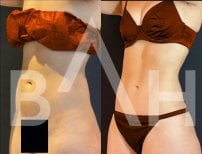 Before and after 360 liposuction results at Büyük Anadolu Hospitals (BAH), body contouring