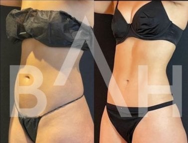 Before and after 360 liposuction results at Büyük Anadolu Hospitals (BAH), body contouring
