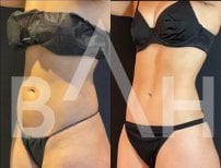 Before and after 360 liposuction results at Büyük Anadolu Hospitals (BAH), body contouring