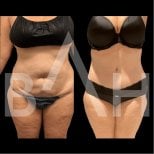 360 liposuction before and after results at Büyük Anadolu Hospitals (BAH), body contouring