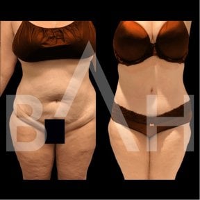 360 liposuction before and after results at Büyük Anadolu Hospitals (BAH), body contouring