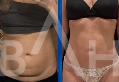Before and after 360 liposuction results at Büyük Anadolu Hospitals (BAH), improved waist contour