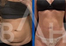 Before and after 360 liposuction results at Büyük Anadolu Hospitals (BAH), improved waist contour