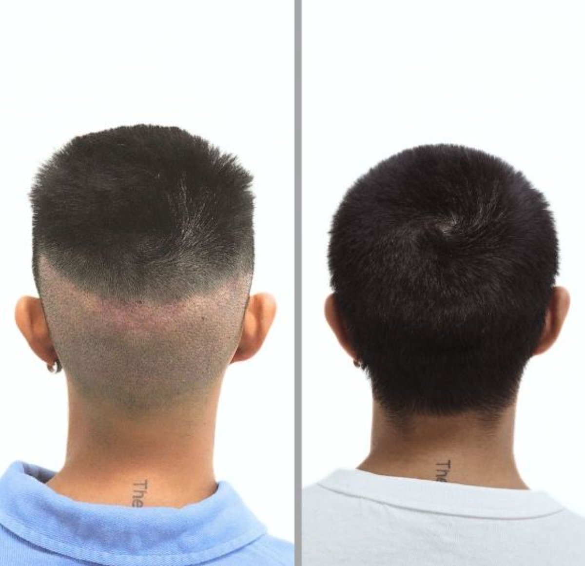 Vorher-nachher-Ergebnis Haartransplantation bei Dr.Nutt Clinic, verbesserte Haardichte