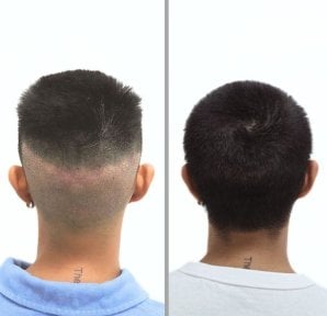 Resultado de trasplante capilar antes y después en Dr.Nutt Clinic, mayor densidad capilar