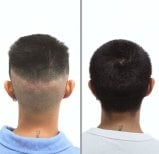 Resultado de trasplante capilar antes y después en Dr.Nutt Clinic, mayor densidad capilar